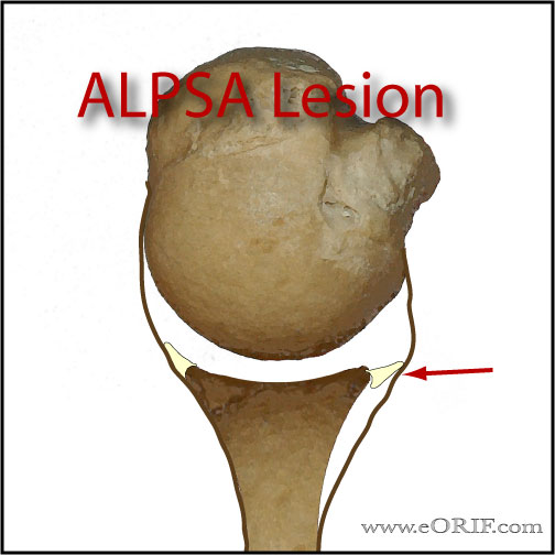 ALPSA lesion picture