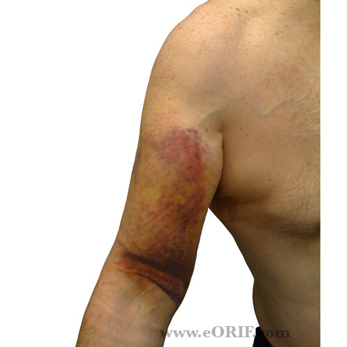 proximal biceps tendon rupture picture