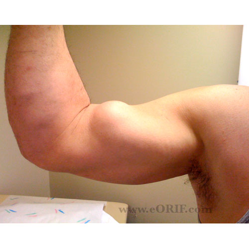 proximal biceps tendon rupture picture