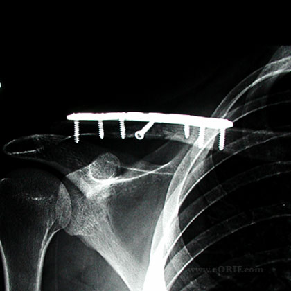 clavicle fracture ORIF xray 