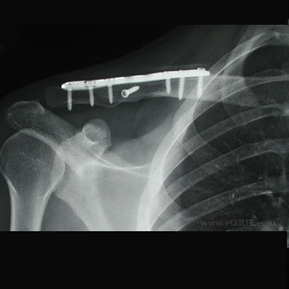 clavicle fracture plate xray