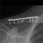clavicle fracture ORIF xray