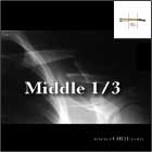 medial 1/3 clavicle fracture 