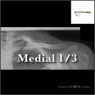 medial clavicle fracture xray