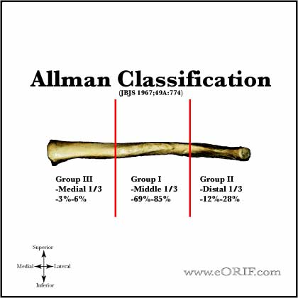 Allman clavicle fracture classification