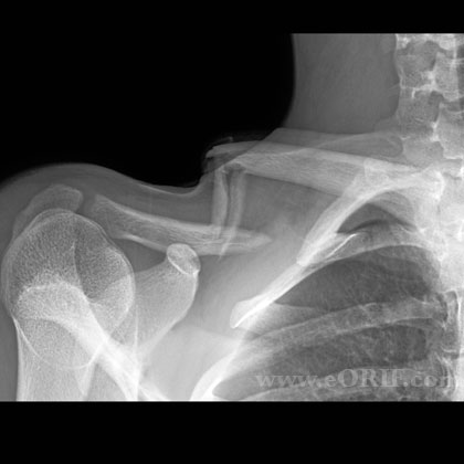 mid shaft clavicle fracture xray
