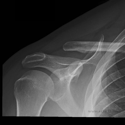 distal clavicle resection complication xray