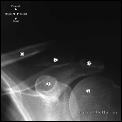 distal clavicle fracture xray