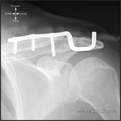 Distal clavicle fracture ORIF xray