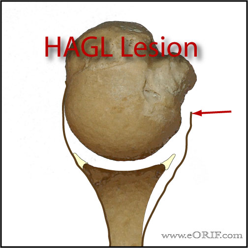 HAGL lesion picture
