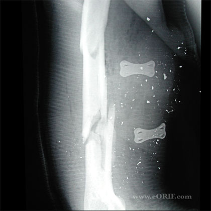 humeral shaft external fixation X-ray