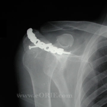 acromion fracture post-op xray