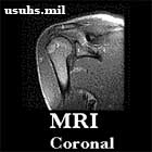 MRI Oblique Coronal