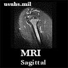 MRI Oblique Sagittal
