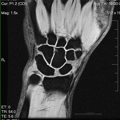 scapholunate ligament tear MRI