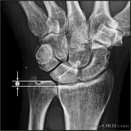 ulnar variance xray ulnar varience xray