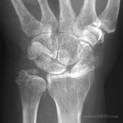wrist arthritis xray image wrist arthritis xray pic