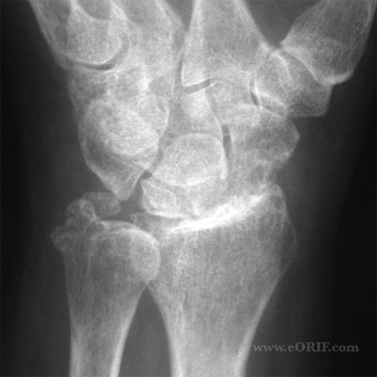 wrist arthritis xray wrist arthritis xray