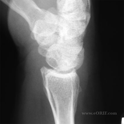 wrist arthritis lateral view xray wrist arthritis lateral view xray