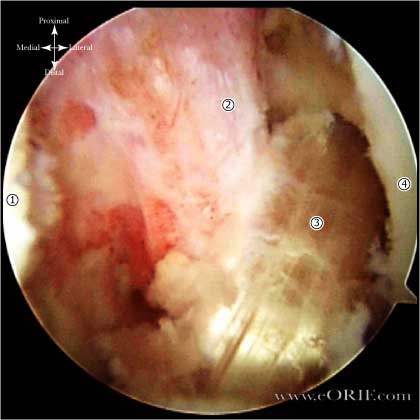 arthroscopic ACL reconstruction picture arthroscopic ACL reconstruction picture