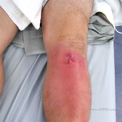 acl infection picture