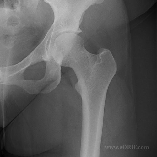 A/P xray view of the hip