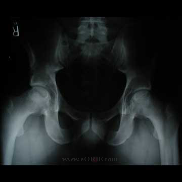 AVN o the hip xray AVN of the hip Xray image