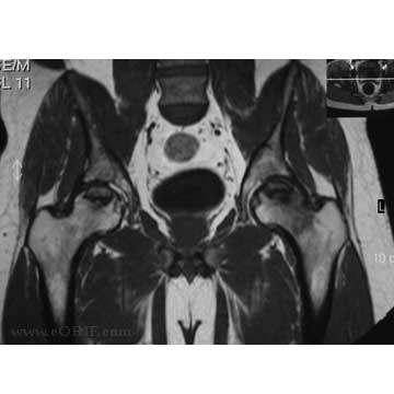 AVN of the Hip AVN of the Hip image