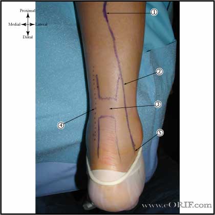 Achilles tendon rupture Achilles tendon rupture image