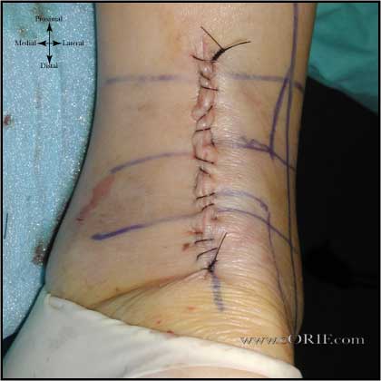 Achilles tendon incision Achilles tendon incision image