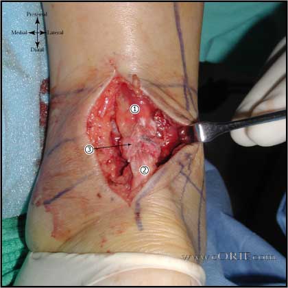 Achilles tendon approach Achilles tendon rupture approach