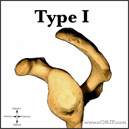 Type I acromion Type I acromion
