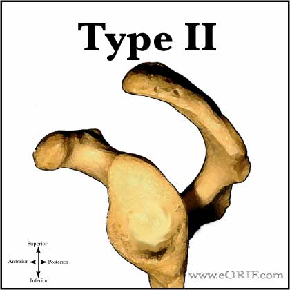 Type II Acromion Type II Acromion