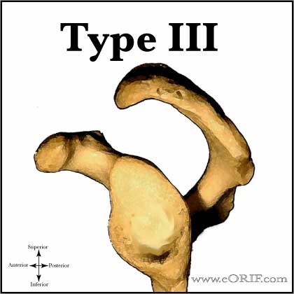 Type III Acromion Type III acromion