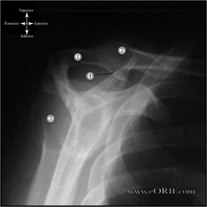 Supraspinatus outlet vew of Type III acromion