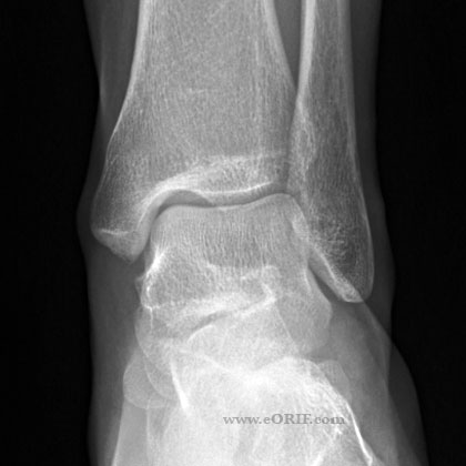 Ankle A/P view xray