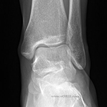 Ankle A/P view Ankle A/P view xray