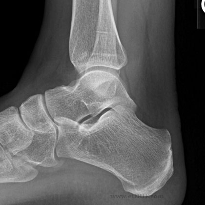 Ankle lateral view xray