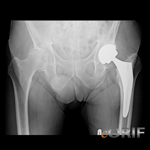 anterior approach THA xray anterior approach THA xray