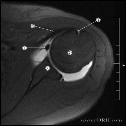 Bankart tear MRI Bankart lesion MRI