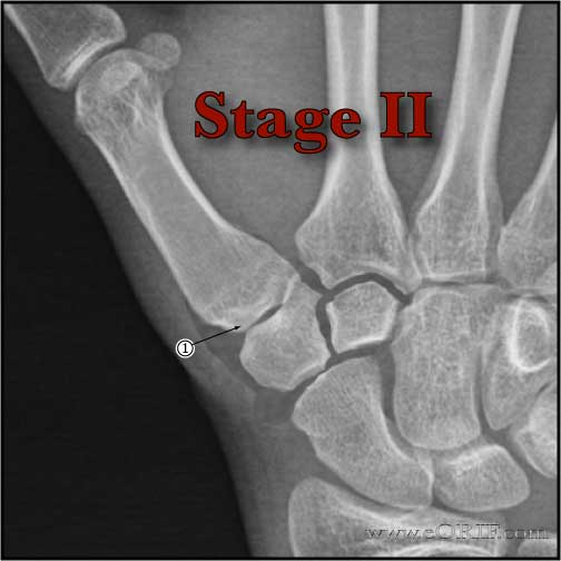 Thumb CMC arthritis Stage II xray Thumb CMC osteoarthritis Stage II xray