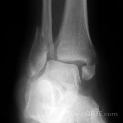 Displaced ankle fracture xray Displaced bimalleolar ankle fracture xray
