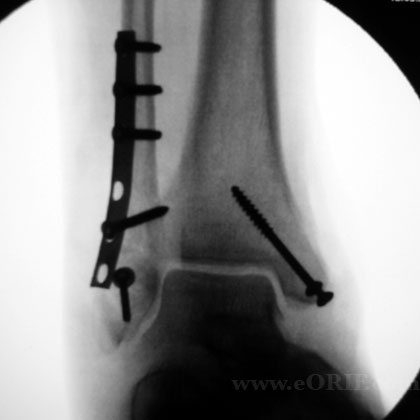 ORIF ankle fracture xray Operative fixation ankle fracture xray
