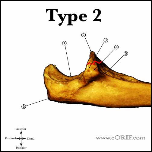 Type II Coronoid Fracture Type II Coronoid Fracture