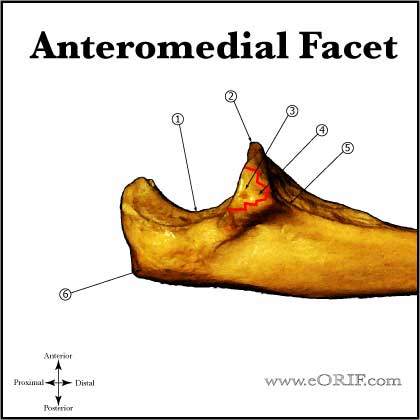 Anteromedial Facet Coronoid Fracture Anteromedial Facet Coronoid Fracture