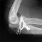 Type III coronoid fracture orif Type III coronoid fracture orif