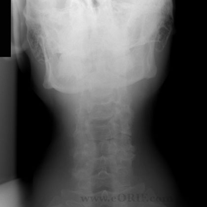 Cervical Spine A/P xray Cervical Spine A/P xray