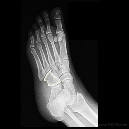Cuboid xray Cuboid tarsal bone xray