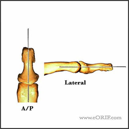 DIP k-wire fixation DIP K-wire fixation