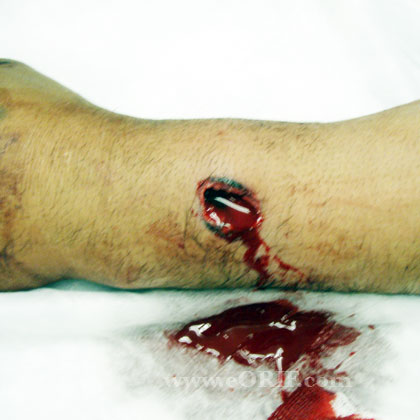 Open distal radius fracture pic Open distal radius fracture